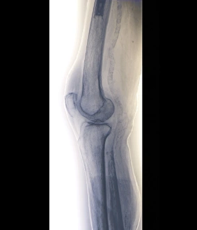Drucke von Arteritiss des Knies. Farbige Röntgenbild vom Kniegelenk eines 85-jährigen Patienten mit Arteritiss Bilder Datiert 2011 August: Knochenarteriosklerose des Kniegelenks (X-Rahmung)