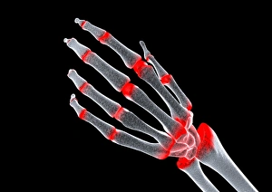 Rheumatoid Arthritis Symptoms Drucke: Arthritic hand