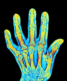 Rheumatoid Arthritis Symptoms Drucke: Arthritic hand bones