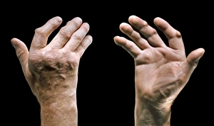 Arthritis Symptoms Drucke: Arthritic hands