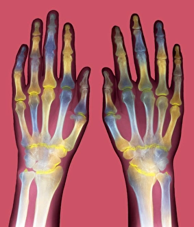 Rheumatoid Arthritis Symptoms Drucke: Arthritic hands, X-ray