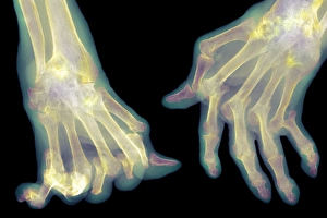 Rheumatoid Arthritis Symptoms Drucke: Arthritic hands, X-ray