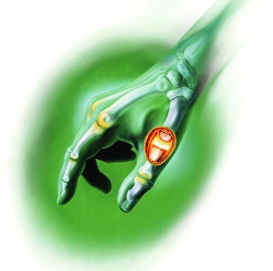 Rheumatoid Arthritis Symptoms Drucke: Arthritis of the thumb joint, artwork