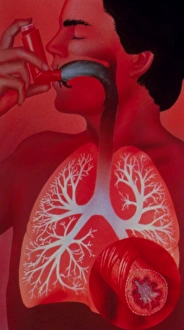 Asthma Treatment Drucke: Asthma inhaler use