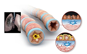 Drucke von Atemwegs Pathologie. Computerkunstwerk zeichnet sich durch Schnittstellen durch einen normalen Atemweg (rechts) und einem asthmatischen, verengten Atemweg (links) Bilder Datiert 2010 Dezember: Asthma-Pathologie, Kunstwerk