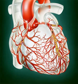 Drucke von Atherosklerosen. Kunstwerk eines menschlichen Herzens mit Enge der Koronararterien aufgrund von Atherosklerosen durch Aufbau von fettigen Depositionen (atheroma, gelb) an der Arteriewand Bilder Datiert 2004 März: Atherosclerosis
