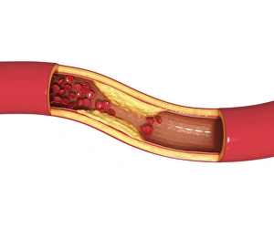 Atherosclerosis Symptoms Drucke: Atherosclerosis, artwork