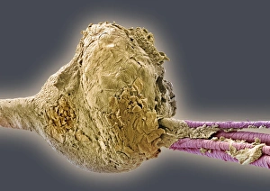 Drucke von Schwarzes Kopfhaar. Farbige Rastertonen-Mikroskopie (SEM) von Haaren, die aus einem Blasen in der Haut auftreten Bilder Datiert 2004 September: Schwarze Schmalzklumpen im SEM