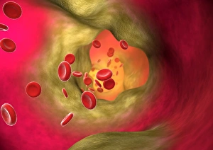 Atherosclerosis Symptoms Drucke: Blocked artery
