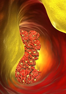 Verstopfte Arterie, Computerkunstwerk