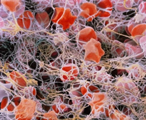 Blood Clot Formation Drucke: Blood clot