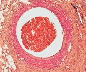 Blood Clotting Process Drucke: Blood clot, light micrograph
