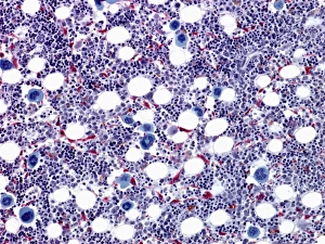 Drucke von Knochenmarkmikroskopie mit großem Blaufarbton. Die großen blauen Zellen sind Megakaryozyten, die Platten bildend sind Bilder Datiert 2010 März: Knochenmark, Lichtmikroskop