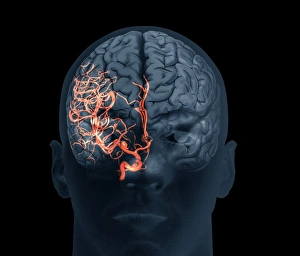 Drucke von Gehirnaneurysma. Mit einem kombinierten 3D-Computertomographie-Angiogramm und einer Magnetresonanzen (MR) Bildgebung des Gehirns eines 38-jährigen Mannes, zeigt ein großes Aneurysma (hell) Bilder Datiert 2013 April: Gehirnaneurysma, 3D-Scan