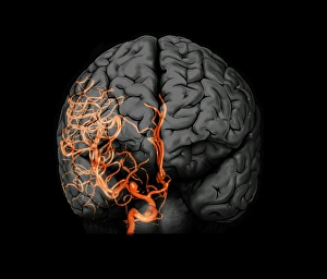 Gehirnaneurysma, 3D-Scan