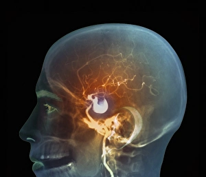 Bilder Datiert 27. März 2013: Gehirnaneurysma, MRT-Scan