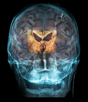 Magnetic Resonance Imaging Scans Drucke: Brain implants for Parkinsons disease