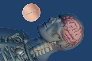Deep Brain Stimulation Drucke: Brain pacemaker, artwork