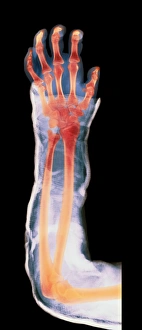 Drucke von Ein gebrochener Arm in Gips. Farbiges Röntgenbild des Arms einer jungen Frau im Gips von Handgelenk bis Oberarm Bilder Datiert 2007 Januar: Brachialgelenk im Plastikgestell und Röntgenbild