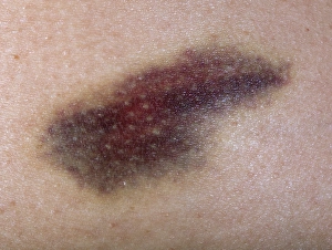 Bilder Datiert 24. August 2012: Verletzte Haut