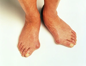 Drucke von Buniones. Jeder dieser flüssig gefüllten Pads bedeckt die Gelenk des großen Zehns Bilder Datiert 2003 Februar: Bunions