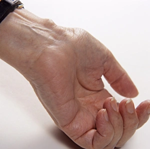 Drucke von Eine entzündete Bursa am Handgelenk einer älteren Frau. Eine Bursa ist ein flüssig gefülltes Becken an Stellen im Körper, wo Haut, Muskeln und Sehnen über Knöchel glatten laufen Bilder Datiert 2005 Juli: Handgelenkbecken