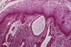 Light Micrograph Images Drucke: Cervical cyst, light micrograph C015 / 6408