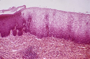 Light Micrograph Images Drucke: Cervical thickening, light micrograph C015 / 6167