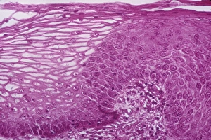 Light Micrograph Images Drucke: Cervical thickening, light micrograph C015 / 6168