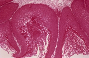 Light Microscopy Images Drucke: Cervical wart, light micrograph C015 / 6055