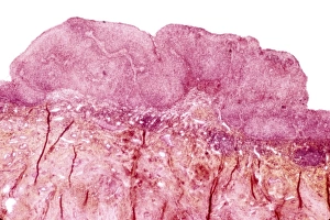 Light Micrograph Images Drucke: Cervical wart, light micrograph C015 / 6747