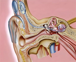 Hörorganimplantat, Kunstwerk