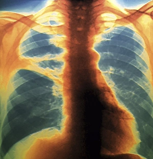 Drucke von Farbenröntgenaufnahme des Brustbeins eines 58-jährigen Patienten mit Kollaps (Atelesie) einer Teilung der oberen Lunge (Orange, links) Bilder Datiert 2011 April: Lungenkollaps (Atelektasie), Röntgenbild