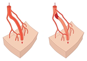 Circulatory System Artwork Drucke: Collateral circulation, artwork