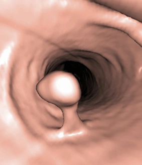 Bilder Datiert 4. März 2013: Kolonpolyp, Bild aus der dreidimensionalen Kolonoskopie