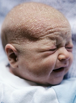 Drucke von MODELL FREIGEBEN. Kräuselkopf bei Neugeborenem Kind mit Kräuselkopf (crusta lactea). Dicke gelbe Skalen in Streifen um den Kopfschmuck des Babys zu sehen Bilder Datiert 2005 September: Kopfkissenhaare
