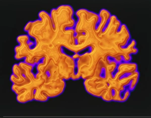 Cerebrum Structure Drucke: CT scan of brain
