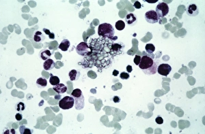 Light Microscopy Images Drucke: Cystine in bone marrow, light micrograph