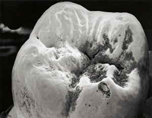 Scanning Electron Micrograph SEM Drucke: Decay on molar tooth, SEM