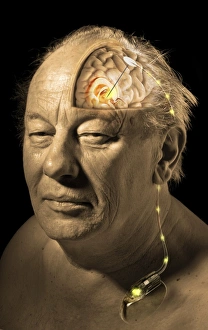 Drucke von MODELL FREIGEBEN. Deep Brainstimulation (DBS), Schnittstelle zur Computerzeichnung Bilder Datiert 2009 März: Tiefenhirnstimulation Kunstwerk