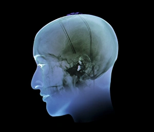 Tiefenhirnstimulation, Röntgenstrahlung