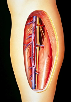 Blood Clot Formation Drucke: Deep vein thrombosis