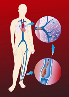 Blood Clot Formation Drucke: Deep vein thrombosis, artwork