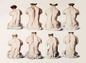 19th Century Medical Illustrations Drucke: Back deformities