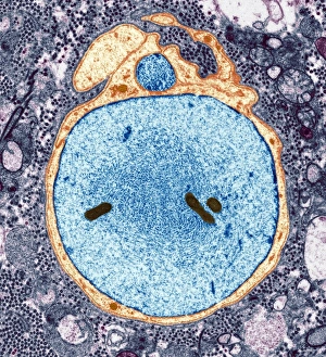 Coloured TEM Micrograph Drucke: Demyelinated nerve in multiple sclerosis