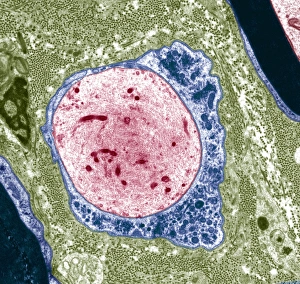 Schwann Cell Function Drucke: Demyelinated nerve, TEM