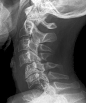 Drucke von Röntgenaufnahme des Halses im Seitenblick bei einem 57-jährigen Patienten, die verletzte Wirbelsäulenwurzel C5/C6 nach einem Autounfall zeigt Bilder Datiert 2011 April: Entsorgte Halsknochen, Röntgenbild