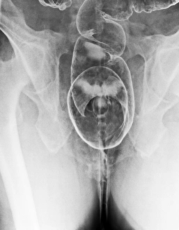 Abdominal Pain Relief Drucke: Diverticulitis C017 / 8015