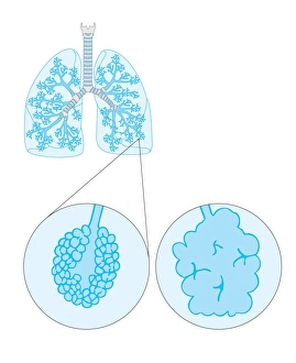 Lung Disease Symptoms Drucke: Emphysema, artwork