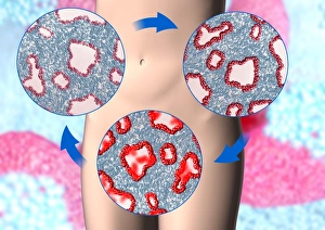 Drucke von Endometriosis ist die Bewegung von Zellen aus der Gebärmutterhaut in den Bauchraum. Die Zellen reagieren immer noch auf das Menstruationszyklus und bluten daher einmal im Monat Bilder Datiert 2005 August: Endometriosis